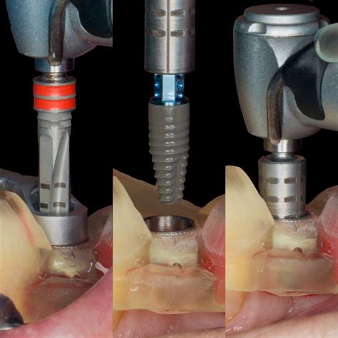 trinon implant course|dental assistant implant courses.